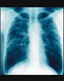 lung xray and benzene.